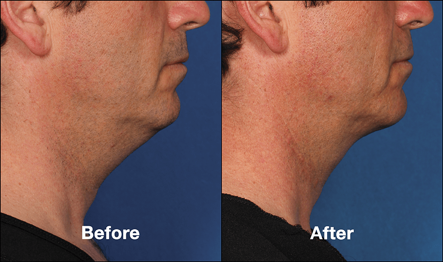 Get rid of your double chin with KYBELLA