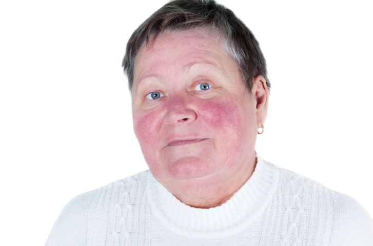 How to Know If You Have Rosacea