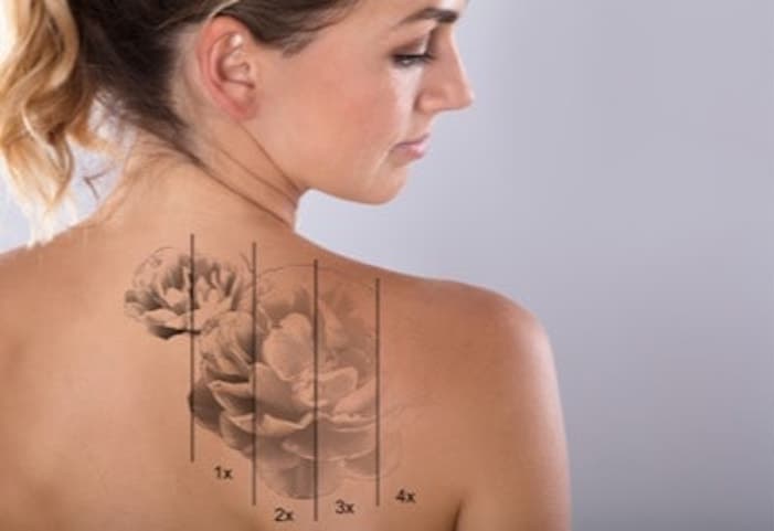 Laser Tattoo Removal Facts