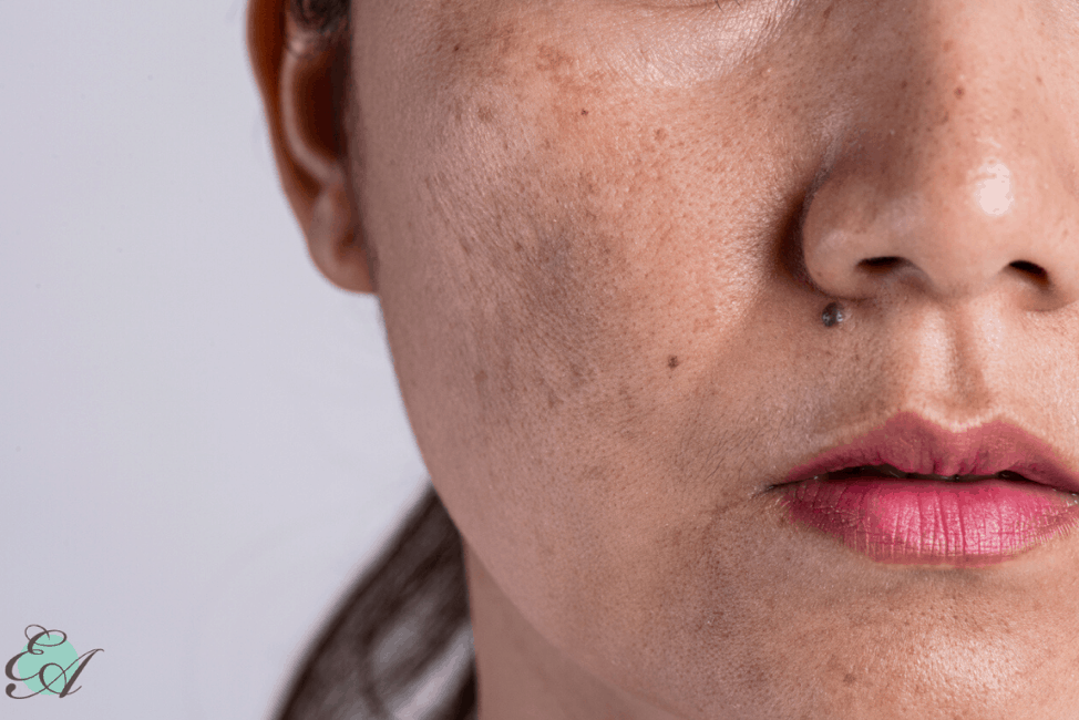 Dark Spots on Face (Melasma): Causes and Treatment