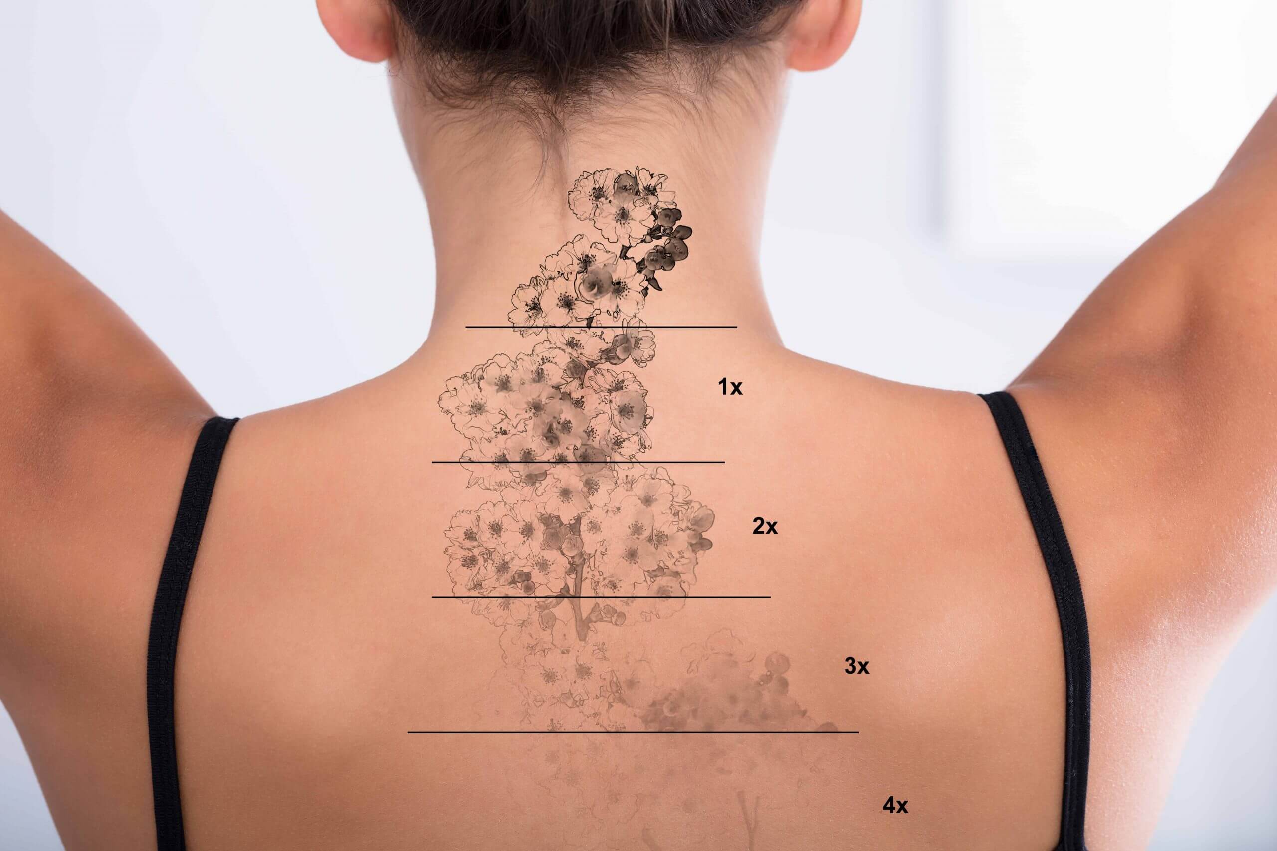 Treatment of a tattoo with a longpulsed hair removal laser resulted in   Download Scientific Diagram