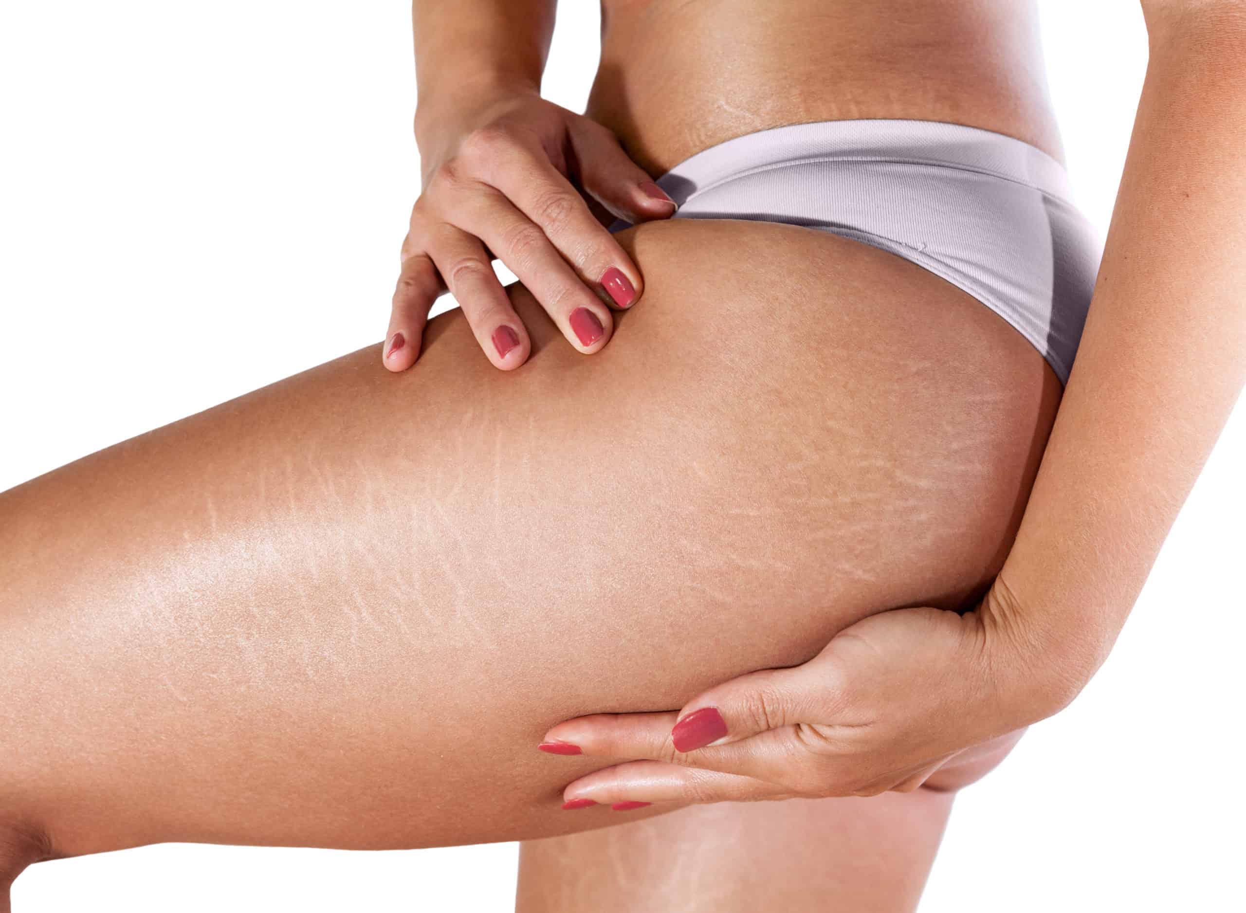 Microneedling For Stretch Marks