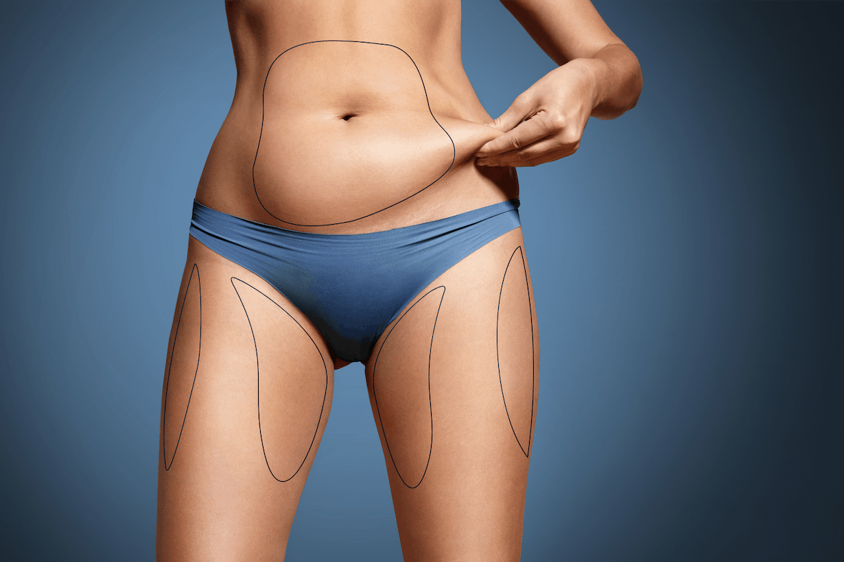 Is CoolSculpting Right for You?