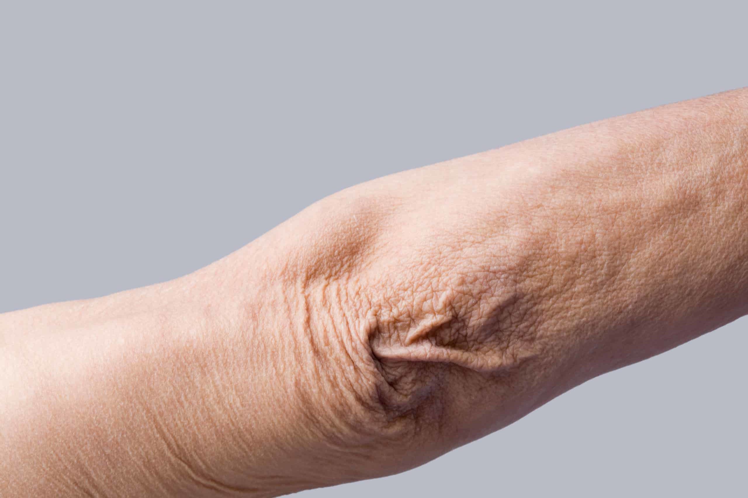 Treat Saggy Arms with Non-Surgical Skin Tightening