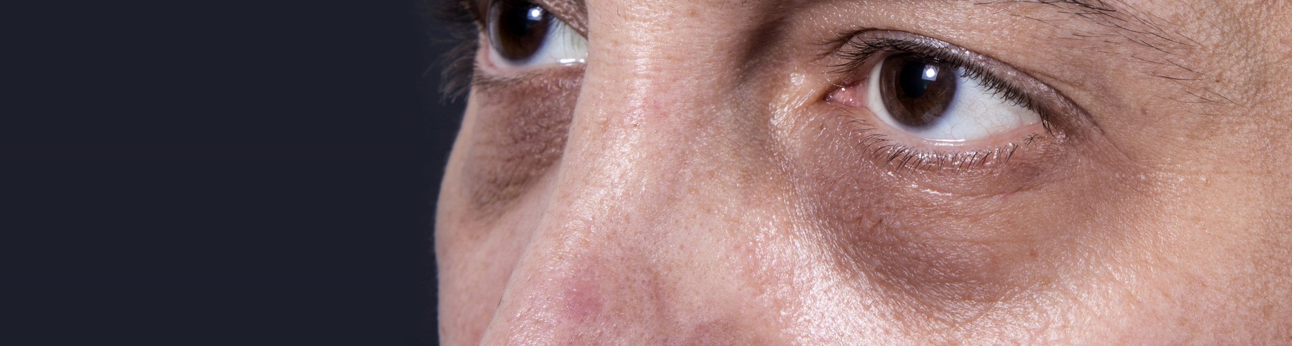 Dark eye circles treatments at Essential Aesthetics