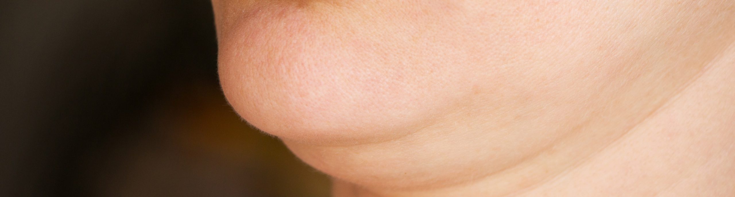 Kybella treatment for double chin at Essential Aesthetics