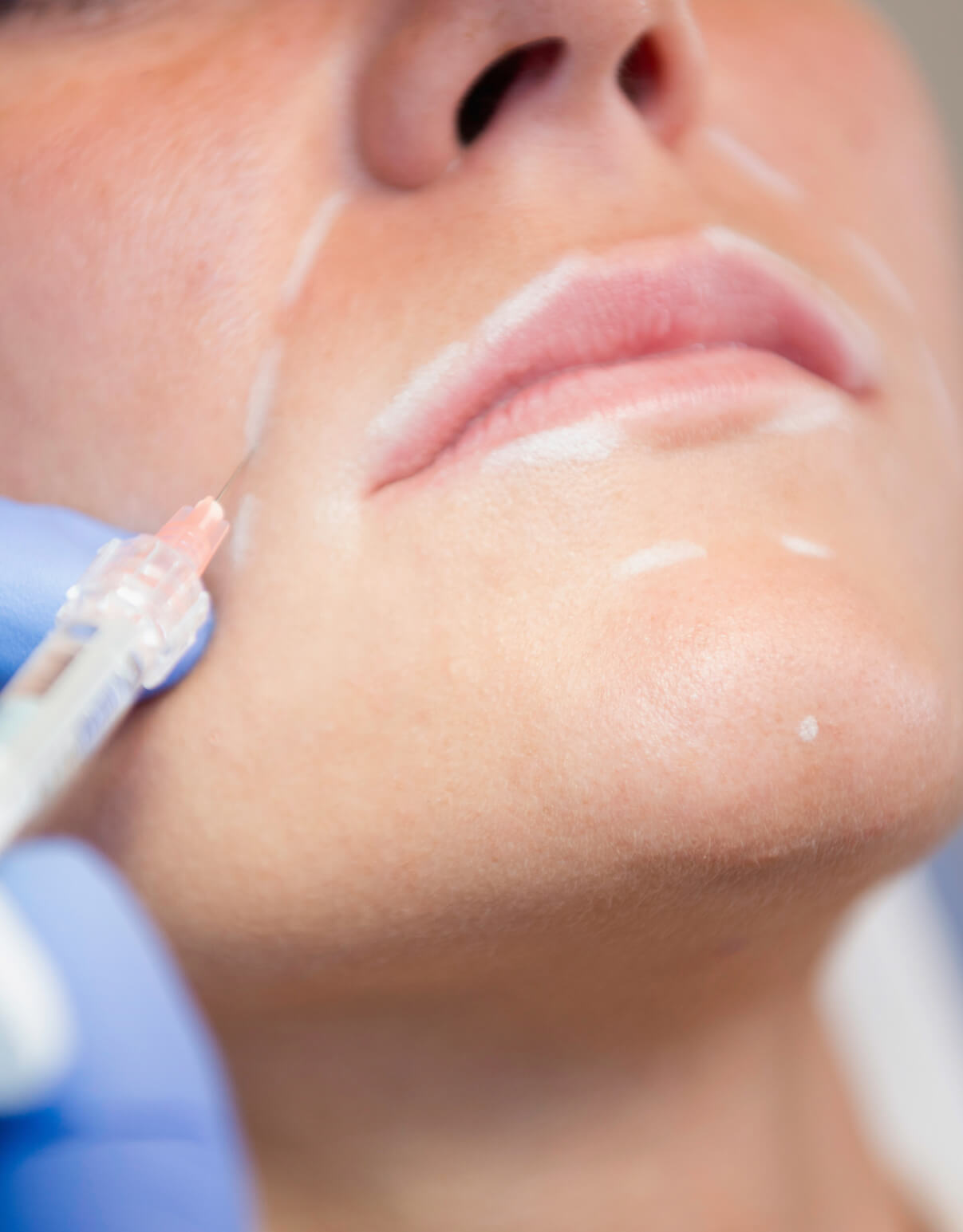Dermal filler treatments for lines and wrinkles at Essential Aesthetics