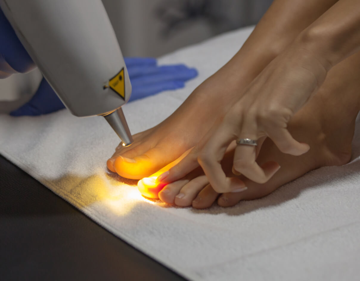 Laser treatments for nail fungus Essential Aesthetics