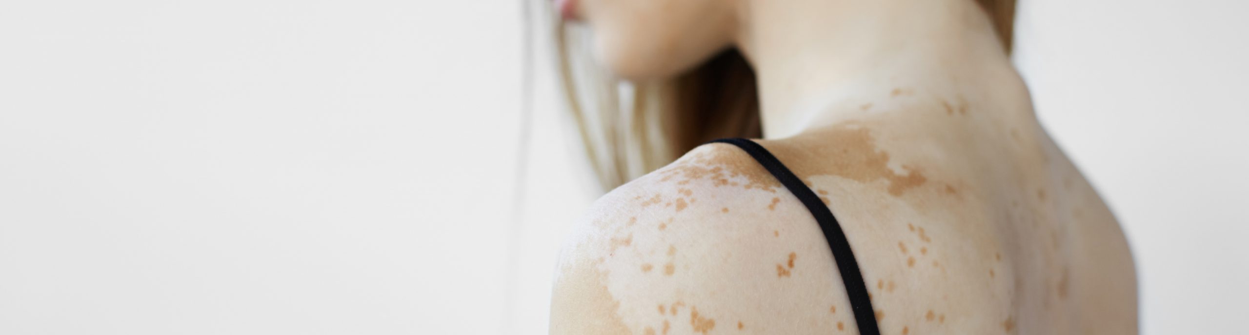Skin pigmentation soluations at Essential Aesthetics