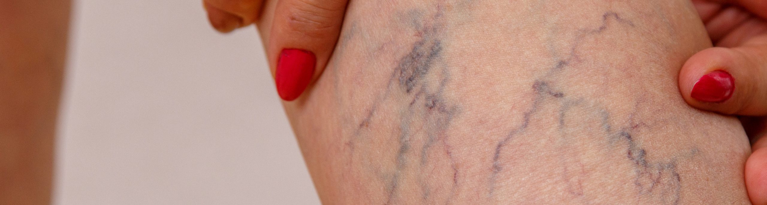 Spider and varicose vein treatments at Essential Aesthetics
