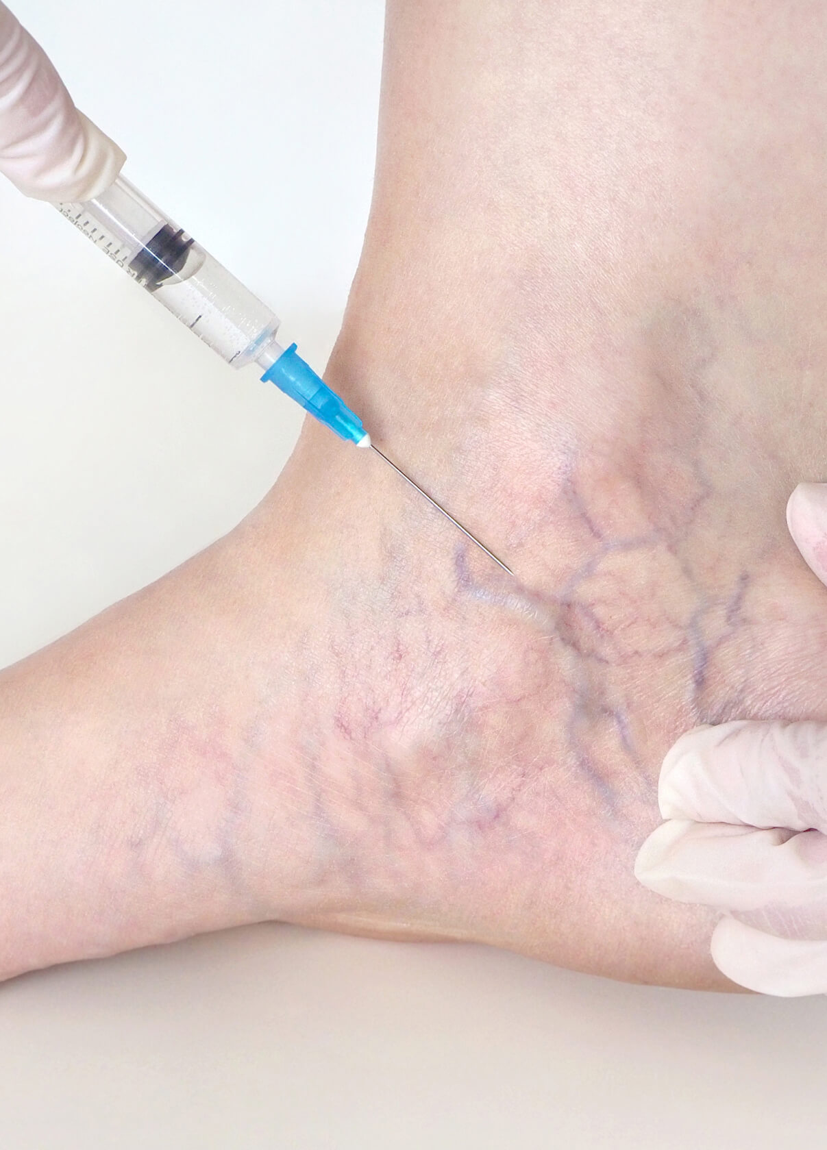 Sclerotherapy at Essential Asethetics for spider and varicose veins