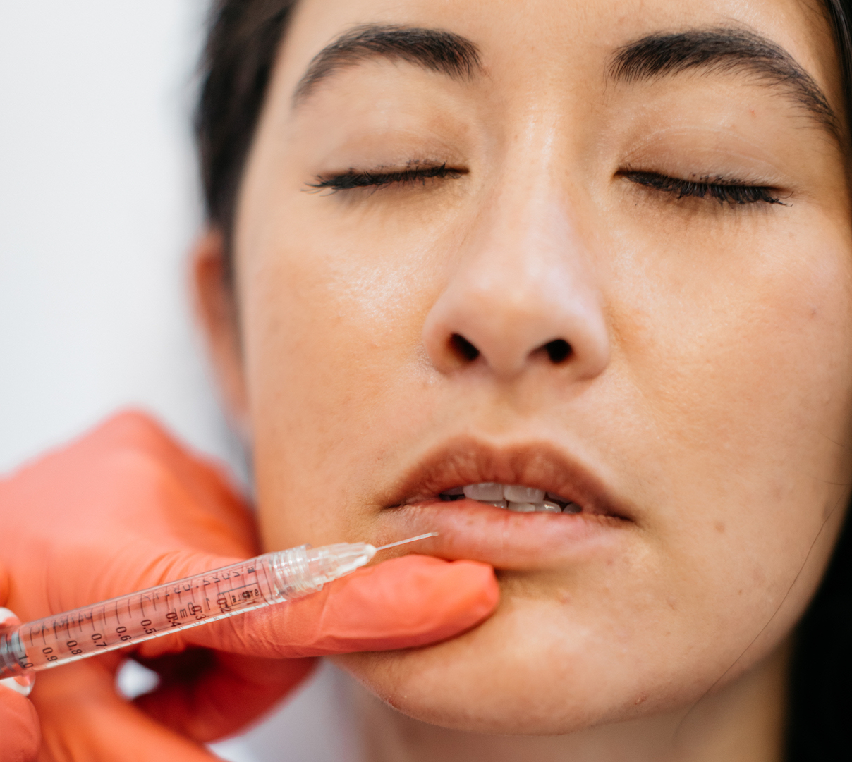 Restylane injections at Essential Aesthetics