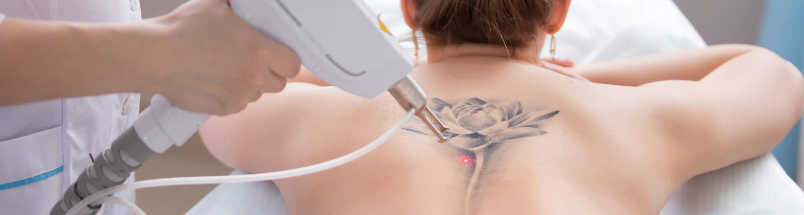 Laser tattoo removal at Essential Aesthetics