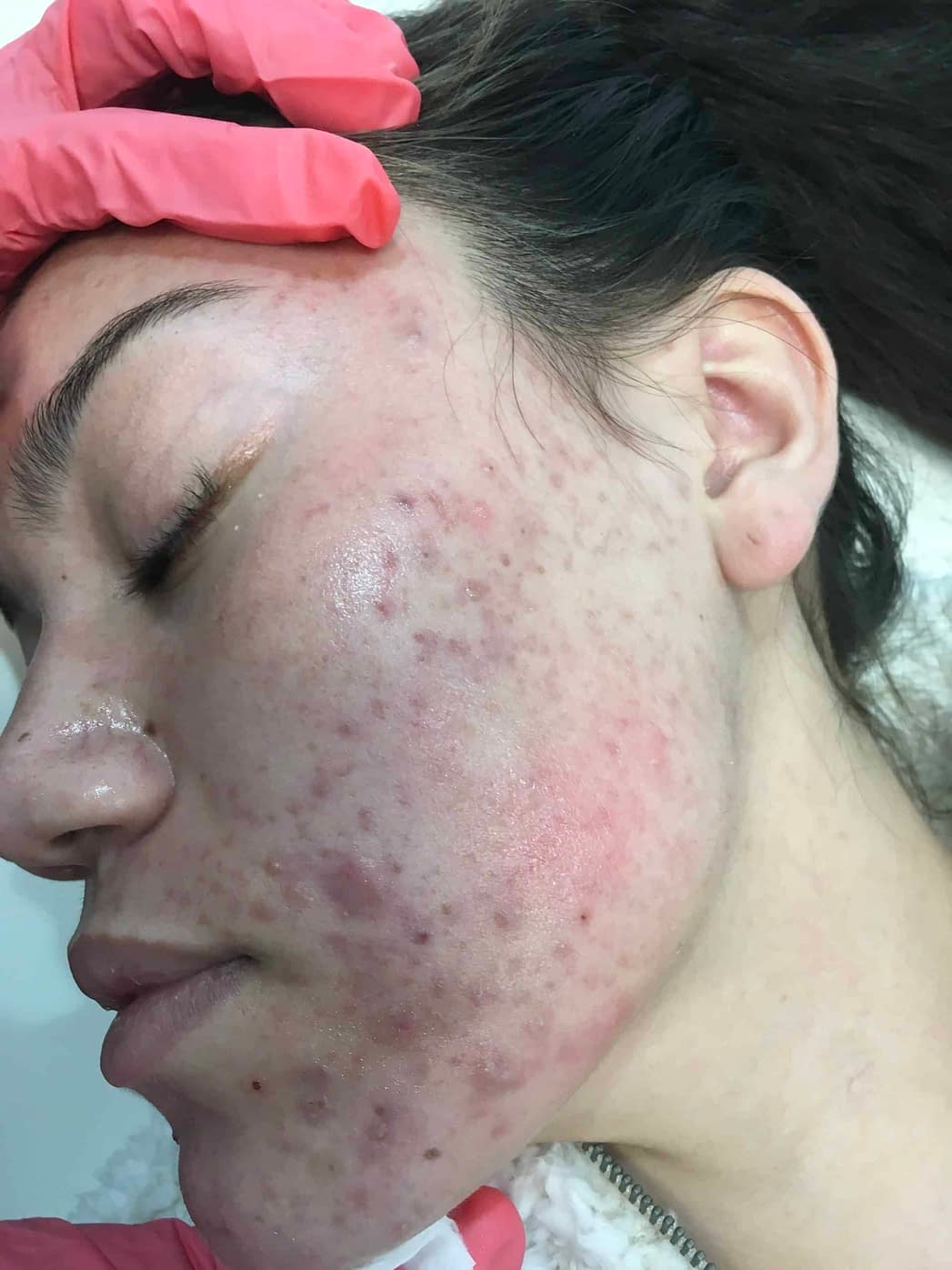 Fastest way to get rid of Cystic Acne
