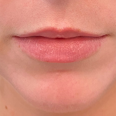 Upper Lip Augmentation 