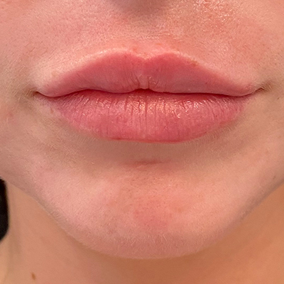 Upper Lip Augmentation 