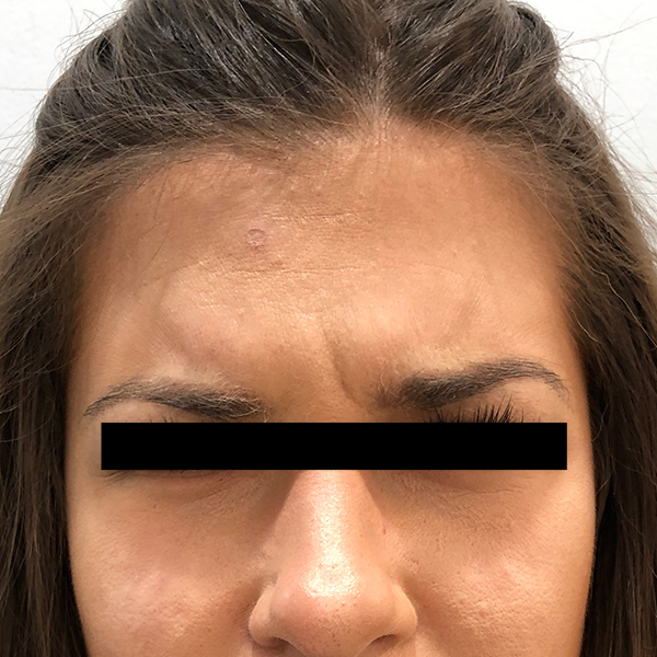 Frown Line Treatment
