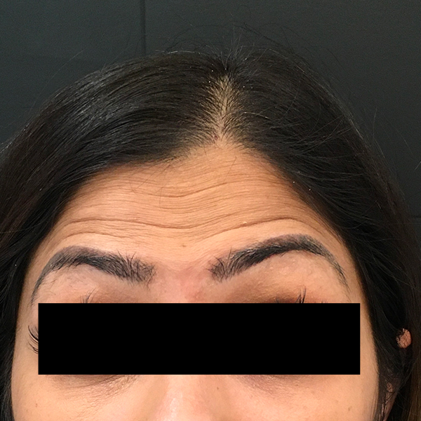 Dynamic Forehead Wrinkle Treatment