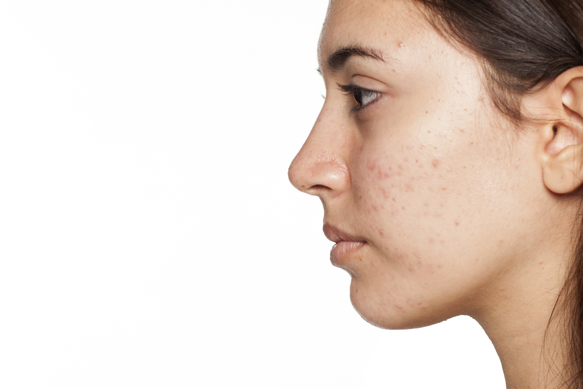 Treating PIH Caused By Acne