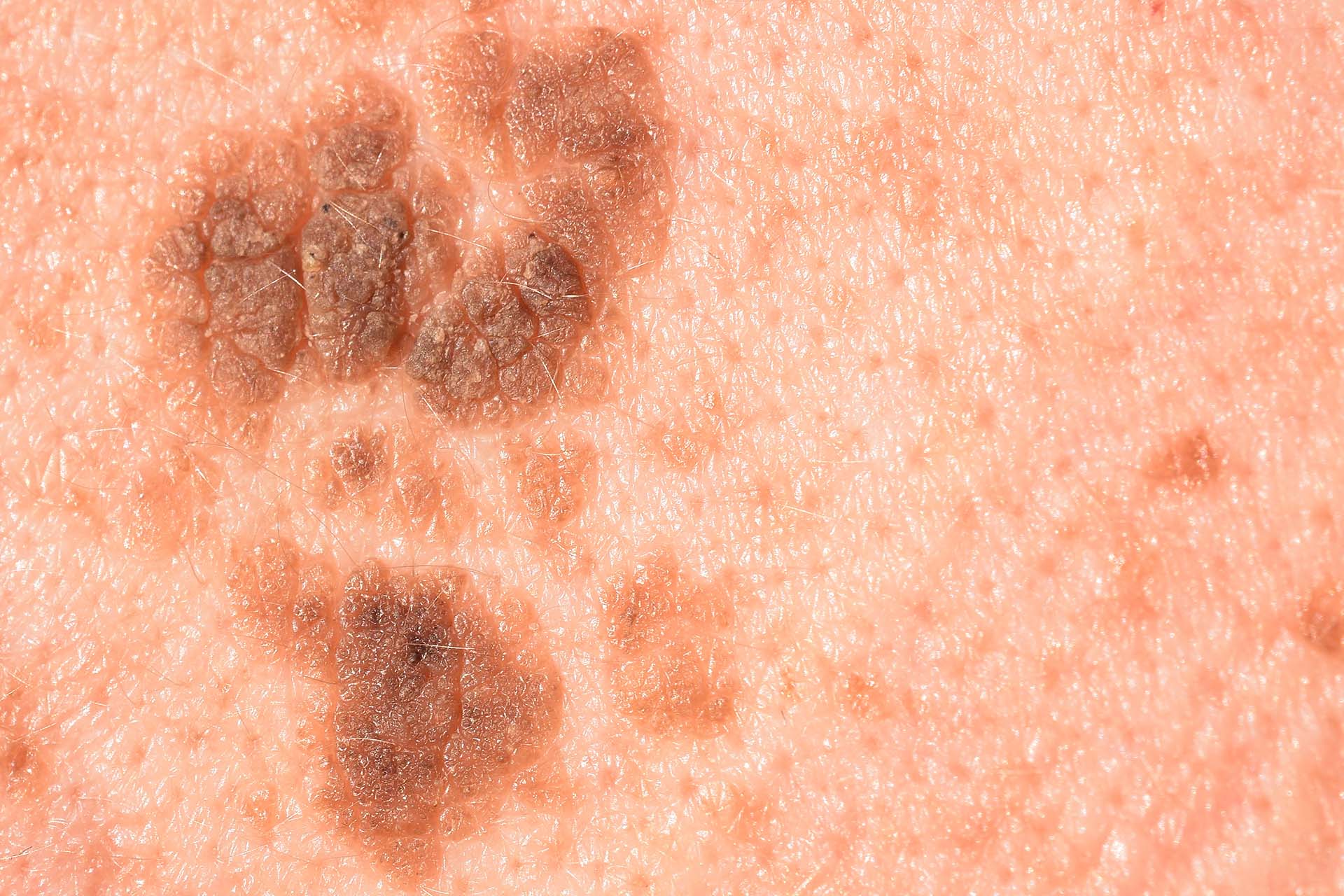 What is Seborrheic Keratosis?