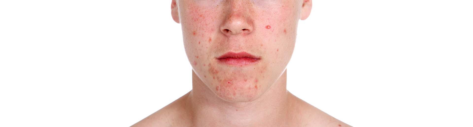 Cystic acne treatments at Essential Aesthetics in Danville CA