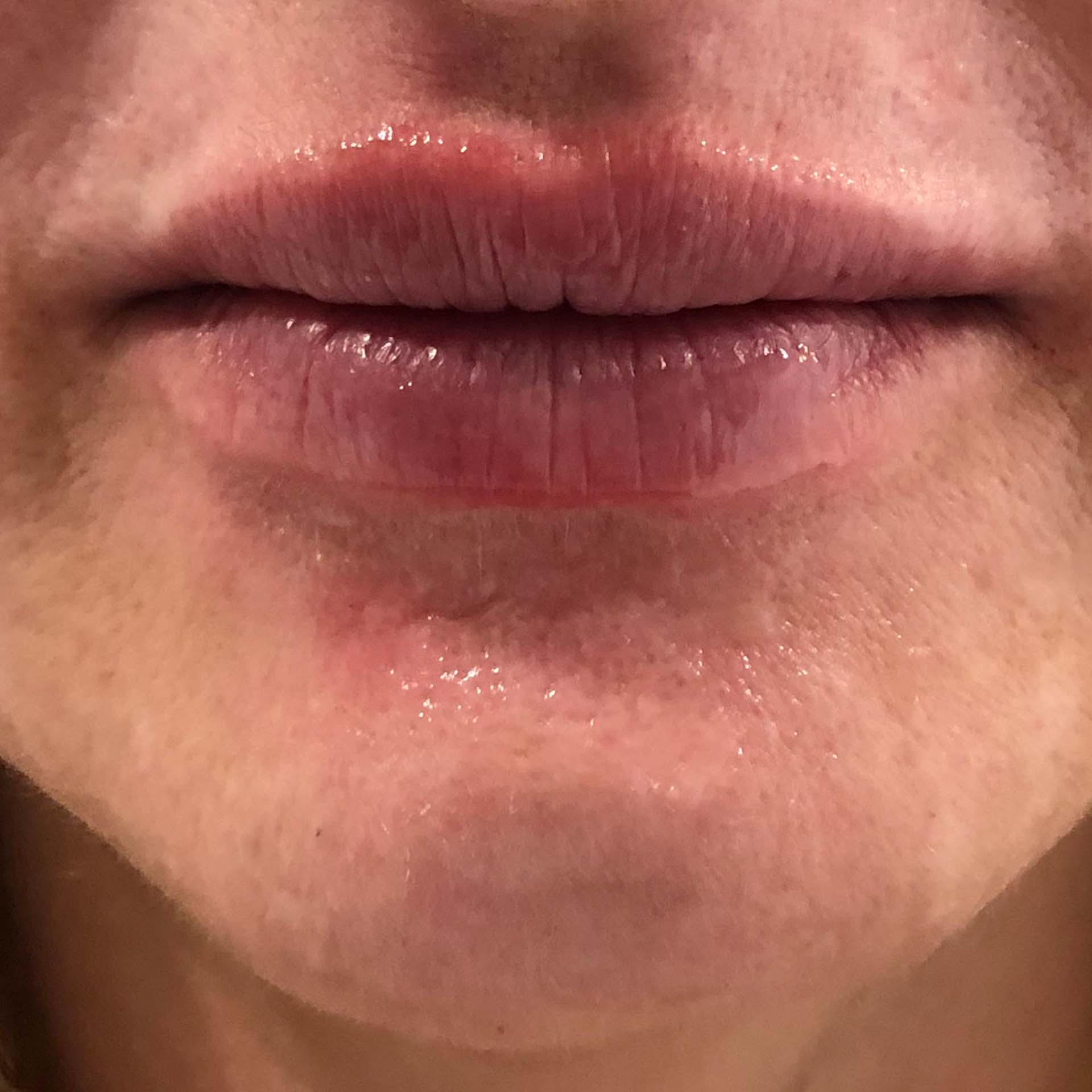 Lip line reshaping, laugh line correction