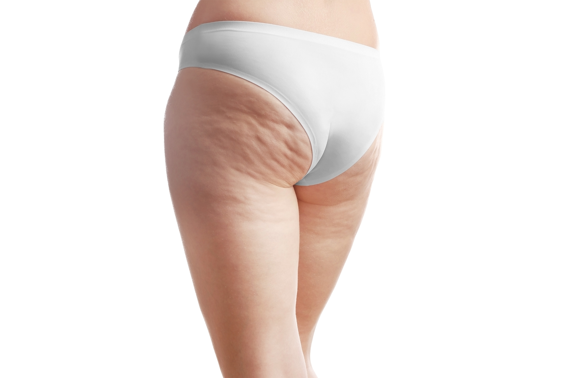 Cellulite Treatment with Qwo
