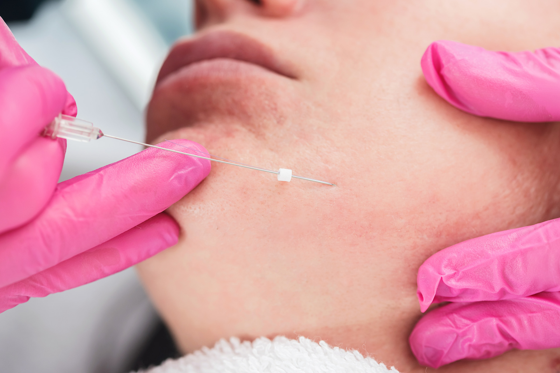 Is getting a facelift using threading an alternative to traditional facelift?