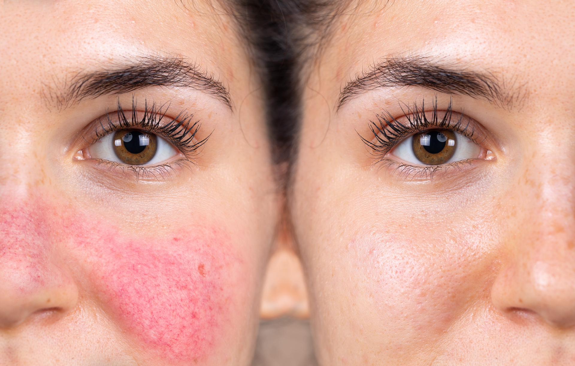 acne rosacea before after