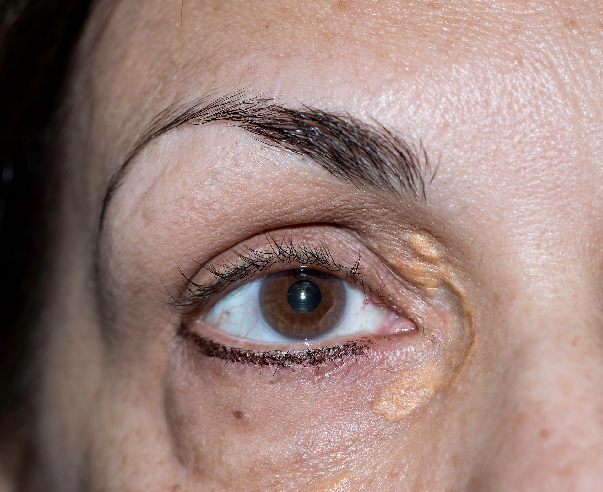 Remove Xanthelasma bumps around your eyelid