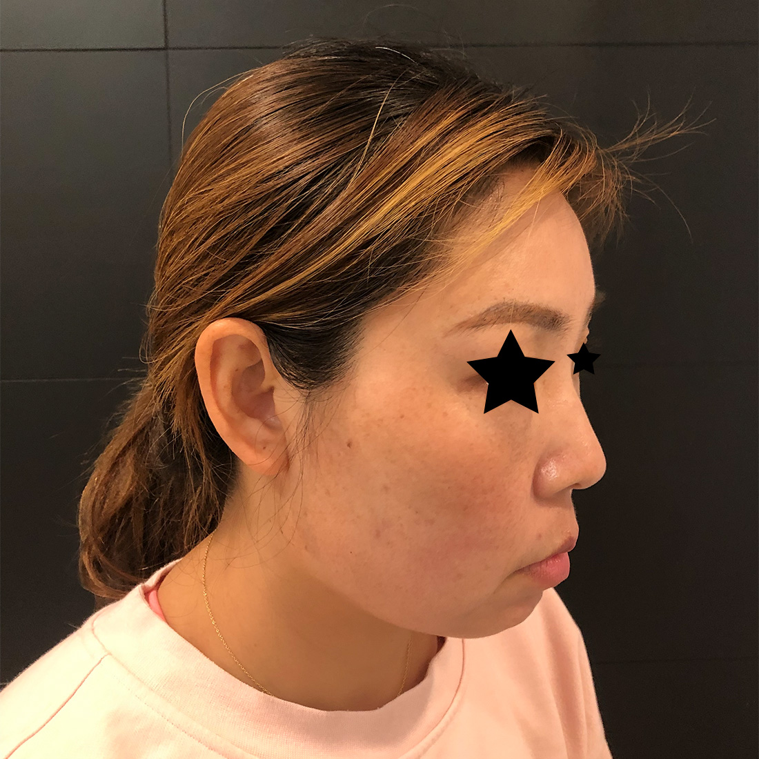 Lower Facial Contouring, Nasal reshaping, profile view