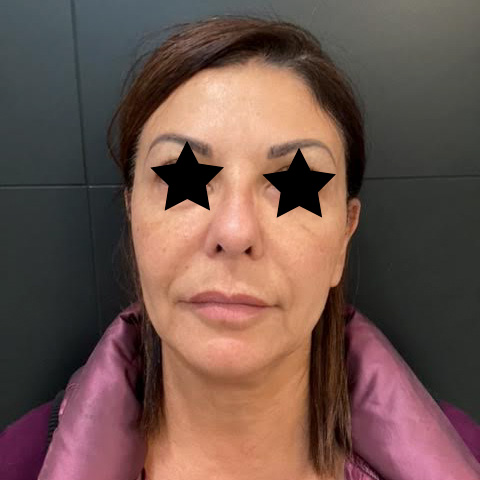 Mid and Lower Facial Rejuvenation