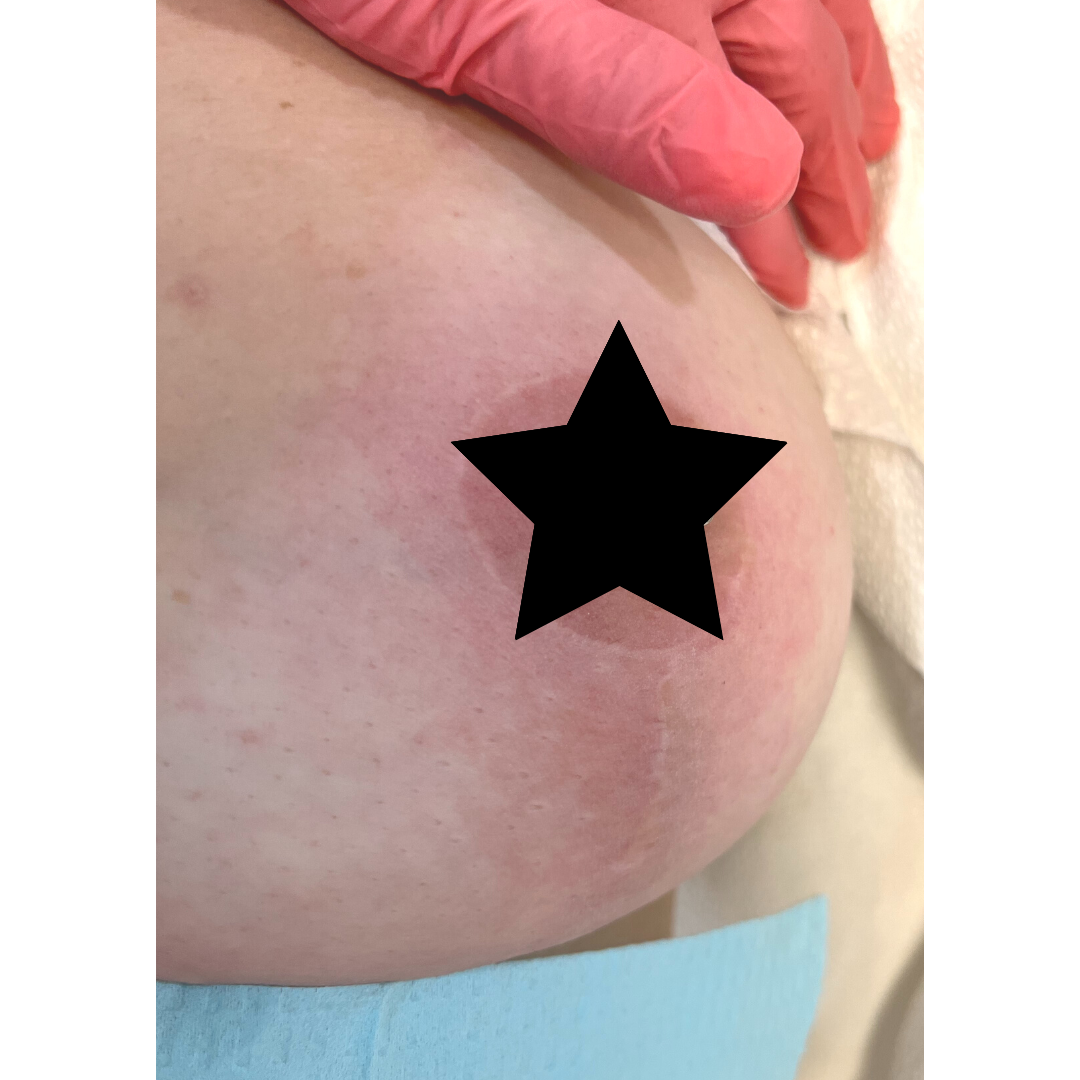 Laser Scar Removal Treatment