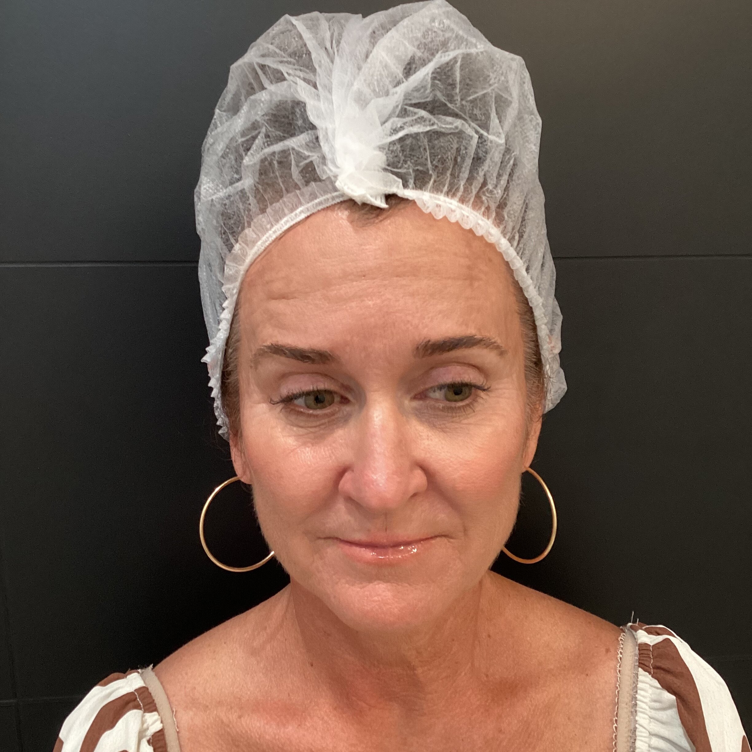 Forehead and Crow's Feet Treatment