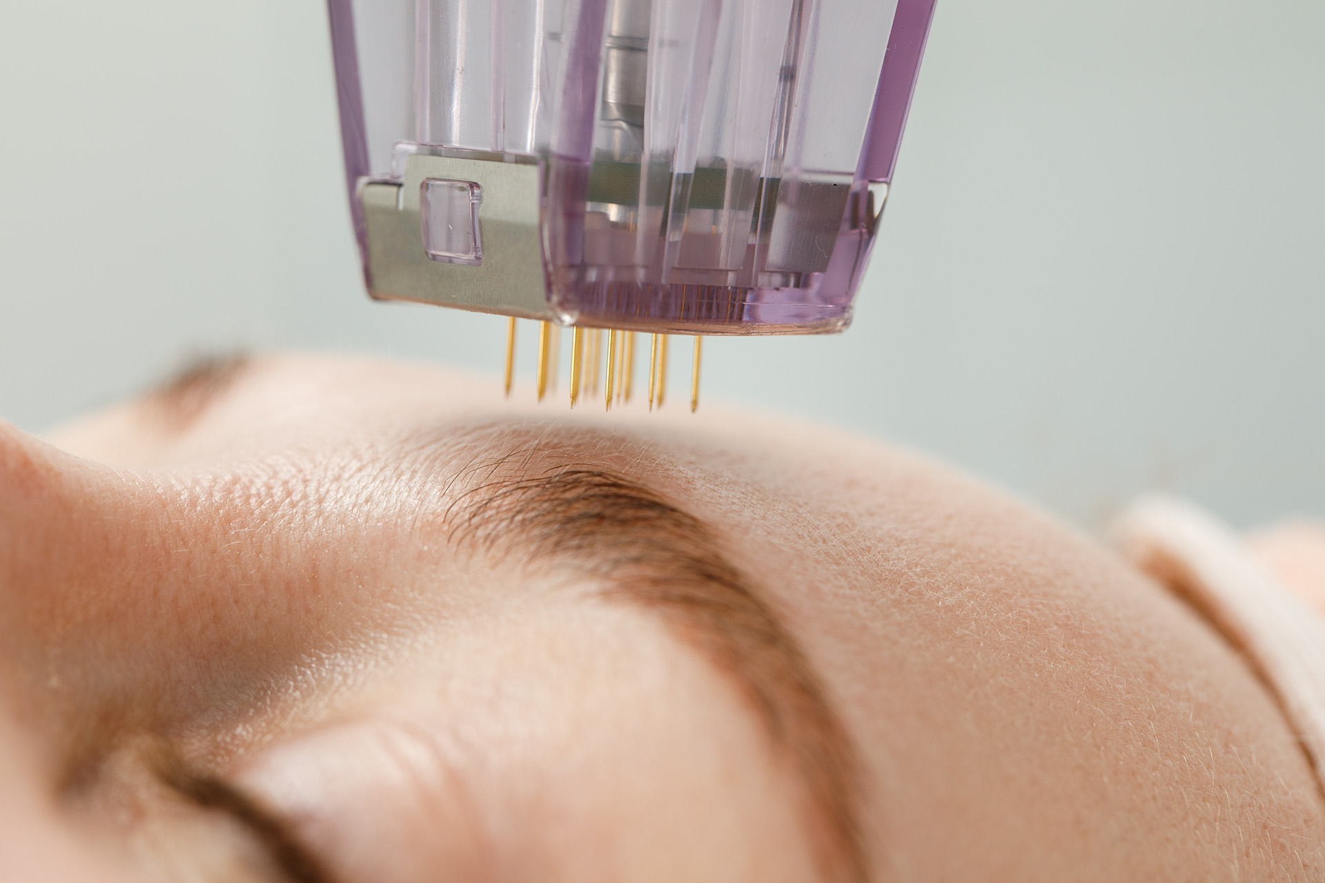 Essential Aesthetics Danville Microneedling Forehead